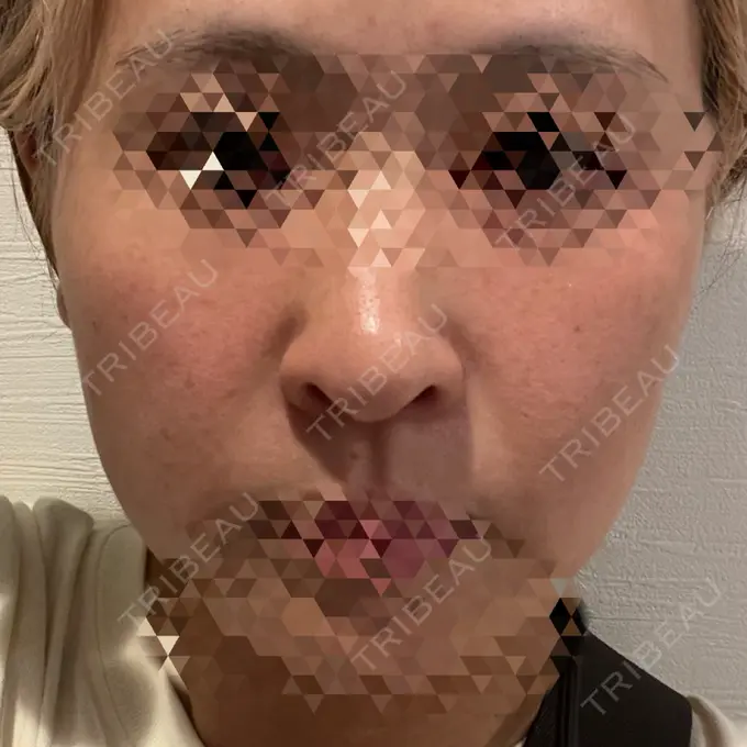 ヒアルロン酸注入（鼻翼基部） サラン鶴橋皮フ科 DAY 12 メイン用