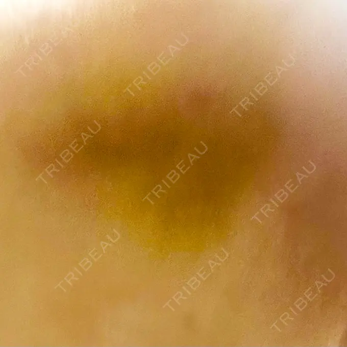 糸リフト / 脂肪吸引（顔） / ジョールファット除去 / 脂肪吸引注射（顔） ziz CLINIC DAY 9 メイン用