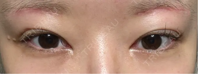 下まぶたの脂肪取り / 眉下切開 東京中央クリニック DAY 18 メイン用