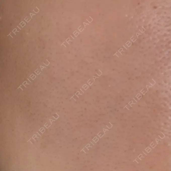 水光注射（ハリ・美肌） Chloe Cheongdam Clinic （クロエチョンダムクリニック） AFTER メイン用