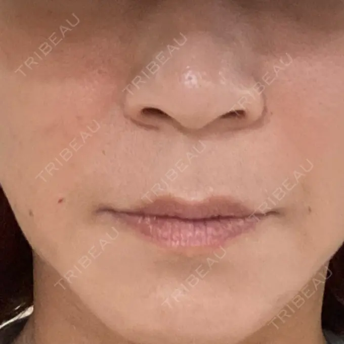 肌ヒアルロン酸注入（たるみ・シワ改善） 東京シルククリニック 東京神田院 AFTER メイン用