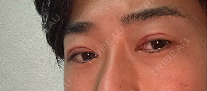 二重埋没 ルラ美容クリニック 渋谷本院 DAY 1 メイン用