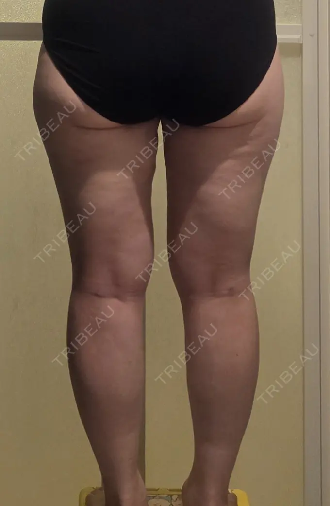 脂肪吸引（顔） / 脂肪吸引（脚） / 脂肪吸引（お尻） GAYA body design clinic DAY 28 メイン用