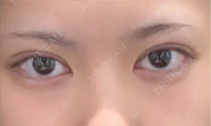 二重埋没 水の森美容クリニック 横浜院 DAY 0 メイン用