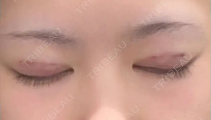 二重埋没 水の森美容クリニック 横浜院 DAY 0 メイン用