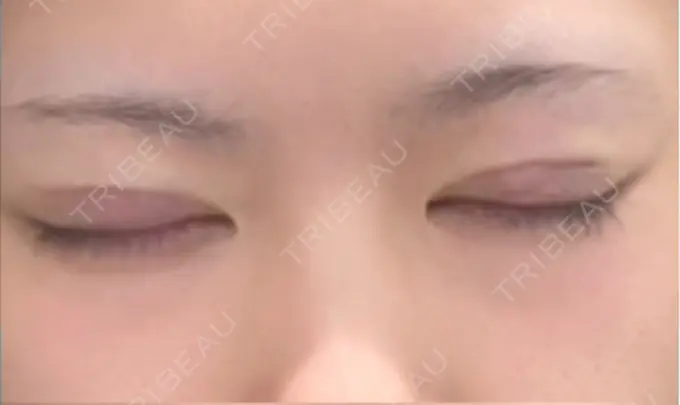 二重埋没 水の森美容クリニック 横浜院 DAY 0 メイン用