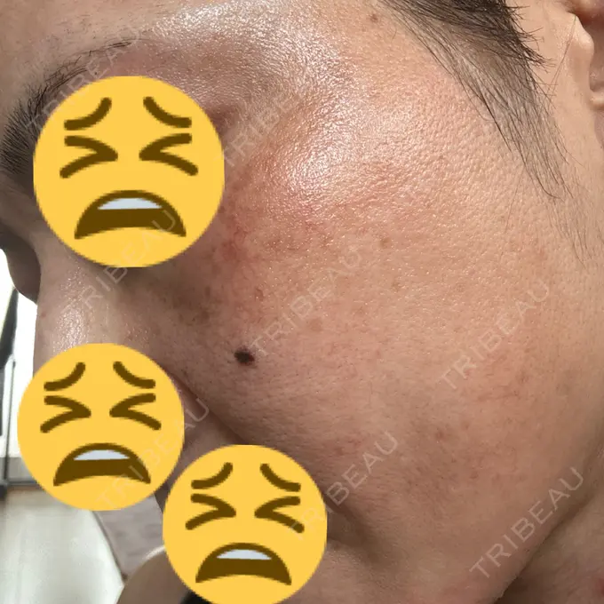 イオン導入 / レーザートーニング（美白・肝斑） 椿クリニック 名古屋院 AFTER メイン用