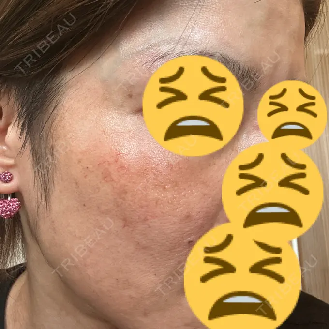 イオン導入 / レーザートーニング（美白・肝斑） 椿クリニック 名古屋院 DAY 16 メイン用