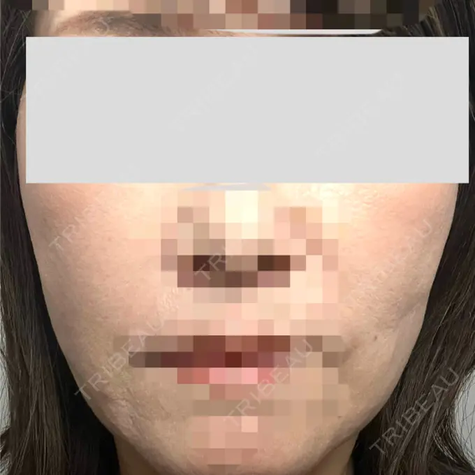 糸リフト / 肌ヒアルロン酸注入（たるみ・シワ改善） gift clinic DAY 23 メイン用