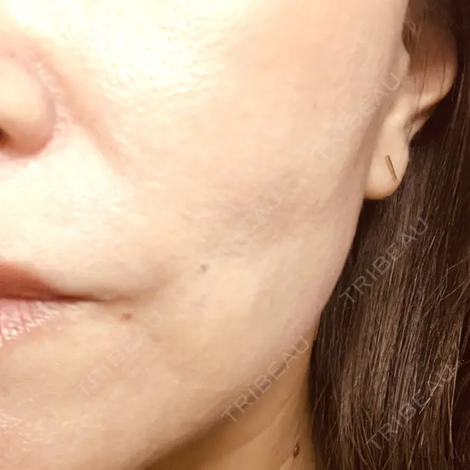 糸リフト / 肌ヒアルロン酸注入（たるみ・シワ改善） gift clinic DAY 23 メイン用