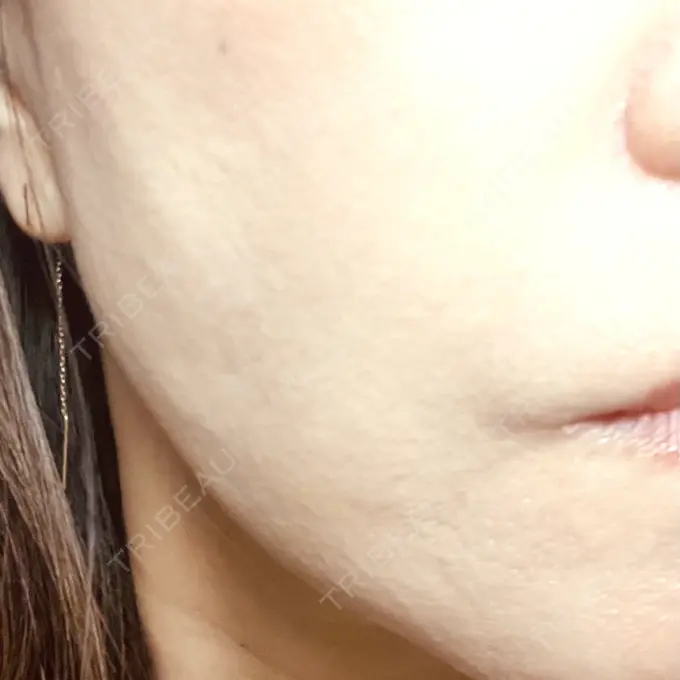 糸リフト / 肌ヒアルロン酸注入（たるみ・シワ改善） gift clinic DAY 23 メイン用