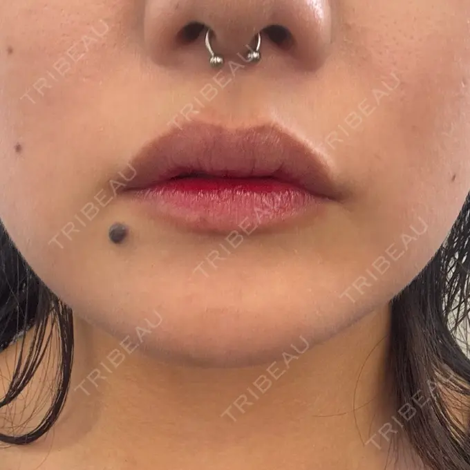 ボトックス（あご） / シワ取りボトックス / ボトックス（人中） 銀座美容外科クリニック 銀座院 DAY 3 メイン用