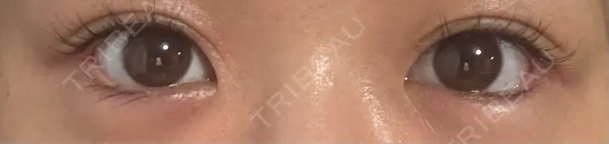 目尻切開 / タレ目形成・グラマラスライン（埋没） / ボトックス（人中） LOUIS CLINIC 二子玉川院【ルイクリニック】 DAY 5 メイン用