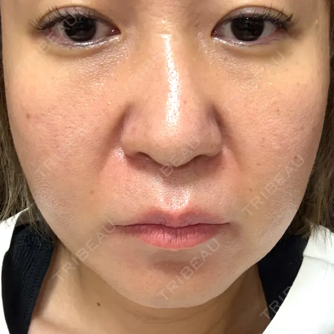 ボトックス（エラ・小顔） フィラークリニック 大阪梅田院 DAY 1 メイン用