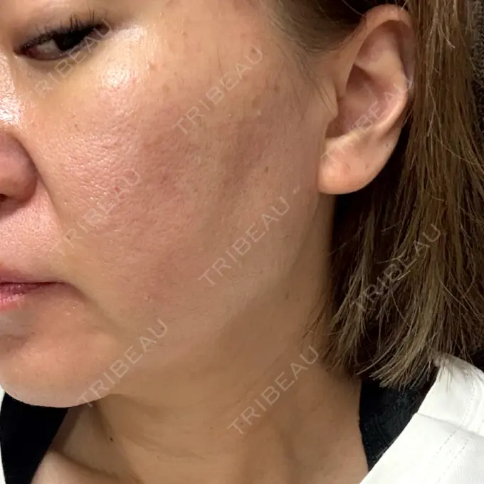 ボトックス（エラ・小顔） フィラークリニック 大阪梅田院 DAY 1 メイン用