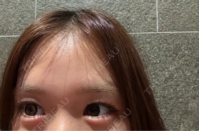 ヒアルロン酸注入（涙袋） / ボトックス（口角） AI Beauty Clinic （エーアイ美容クリニック） AFTER メイン用