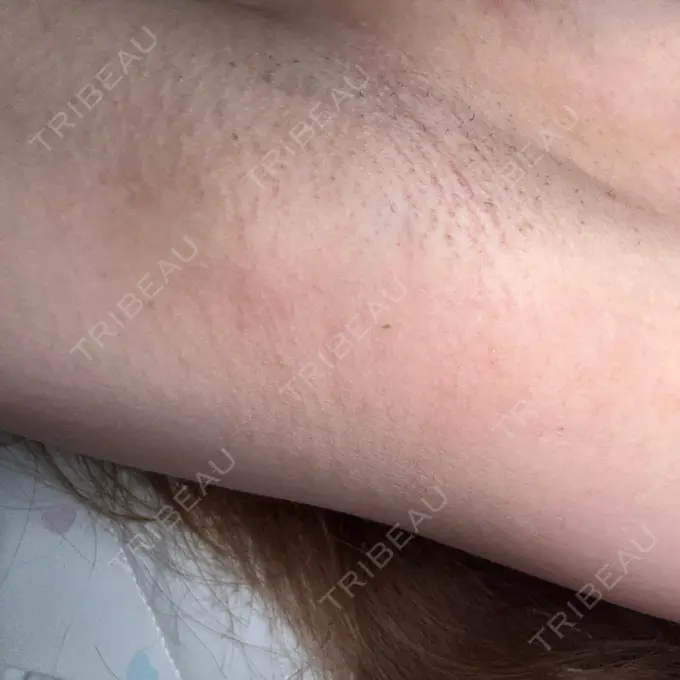 医療脱毛（ワキ） ルラ美容クリニック 神戸院 AFTER メイン用