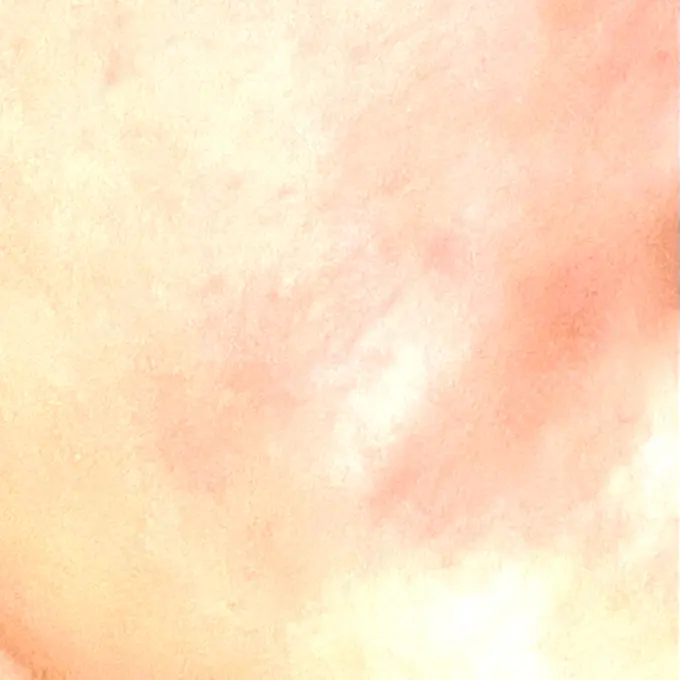 糸リフト / 脂肪吸引（顔） / ジョールファット除去 / 脂肪吸引注射（顔） ziz CLINIC DAY 10 メイン用