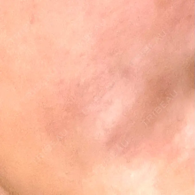 糸リフト / 脂肪吸引（顔） / ジョールファット除去 / 脂肪吸引注射（顔） ziz CLINIC DAY 10 メイン用