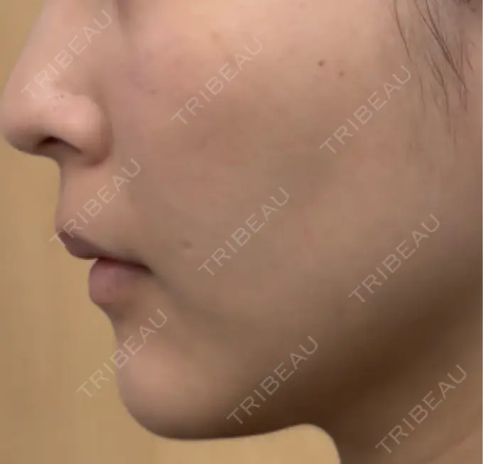 RF（高周波）たるみ治療 共立美容 池袋院 DAY 10 メイン用