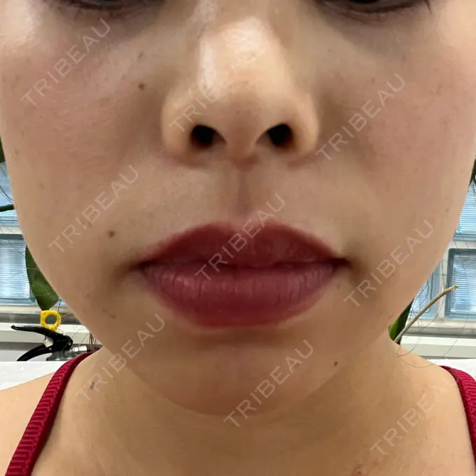 ハイフ（顔） Designo Clinic （デジーノクリニック） DAY 3 メイン用