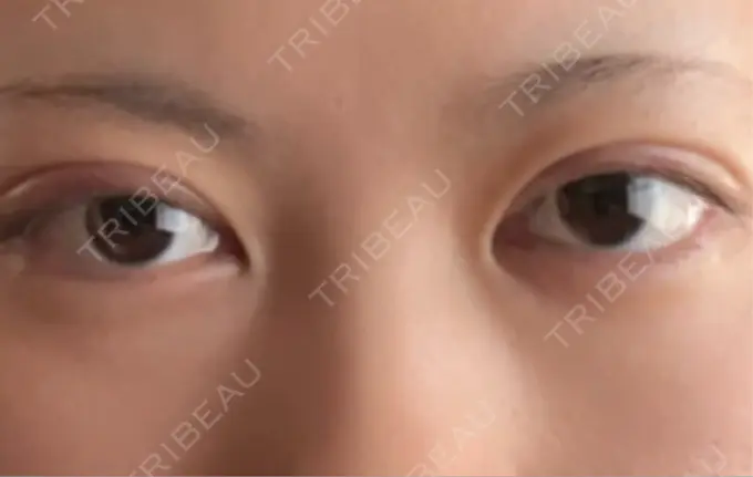 二重埋没 水の森美容クリニック 横浜院 AFTER メイン用