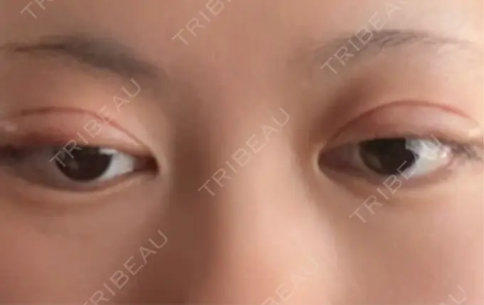 二重埋没 水の森美容クリニック 横浜院 DAY 1 メイン用