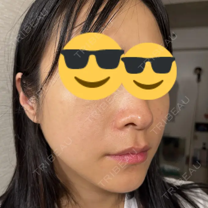 レーザートーニング（美白・肝斑） MAクリニック 心斎橋 DAY 5 メイン用