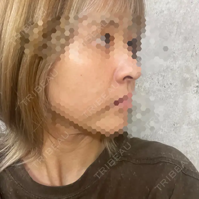 ヒアルロン酸注入（鼻翼基部） サラン鶴橋皮フ科 DAY 19 メイン用