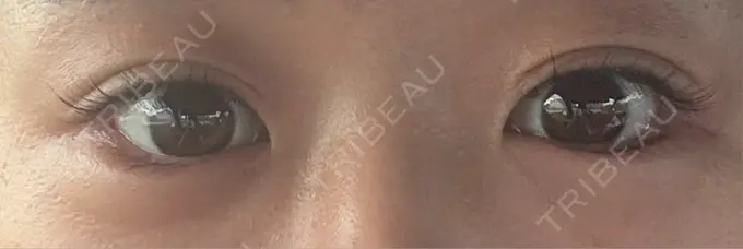 目尻切開 / タレ目形成・グラマラスライン（埋没） / ボトックス（人中） LOUIS CLINIC 二子玉川院【ルイクリニック】 AFTER メイン用