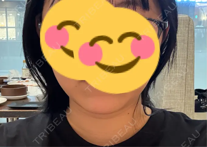 脂肪吸引（顔） / 脂肪吸引注射（顔） ziz CLINIC AFTER メイン用