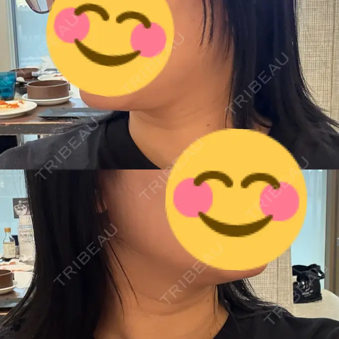 脂肪吸引（顔） / 脂肪吸引注射（顔） ziz CLINIC DAY 17 メイン用