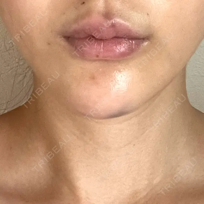 糸リフト アリエル美容クリニック 横浜院 DAY 3 メイン用