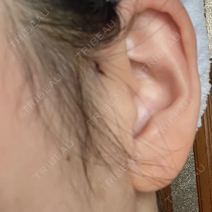 糸リフト アリエル美容クリニック 横浜院 DAY 3 メイン用