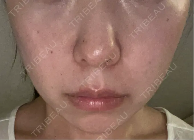 ハイフ（顔） 東京美容外科 池袋院 AFTER メイン用