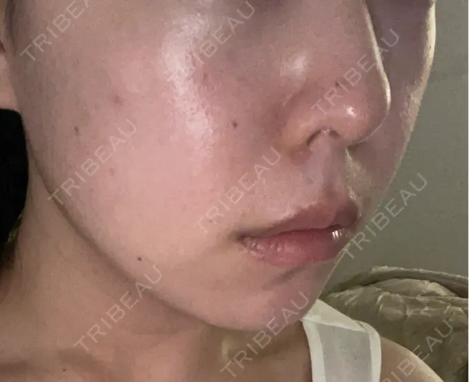 ハイフ（顔） 東京美容外科 池袋院 DAY 1 メイン用