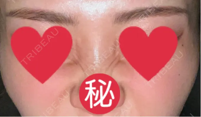 ボトックス（バニーライン） 共立美容外科 広島院 DAY 37 メイン用