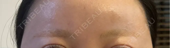 アートメイク除去・修正 ライズワン美容皮膚科クリニック AFTER メイン用