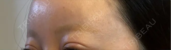 アートメイク除去・修正 ライズワン美容皮膚科クリニック DAY 30 メイン用