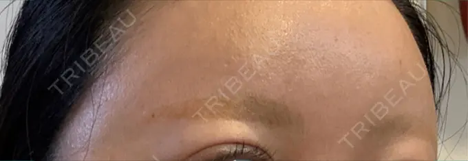 アートメイク除去・修正 ライズワン美容皮膚科クリニック DAY 30 メイン用