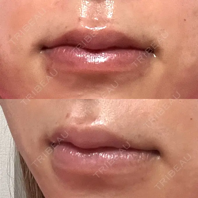 ヒアルロン酸注入（唇） 大美会クリニック 神戸院 DAY 3 メイン用
