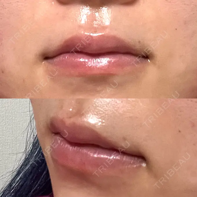 ヒアルロン酸注入（唇） 大美会クリニック 神戸院 DAY 4 メイン用