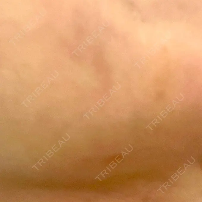 糸リフト / 脂肪吸引（顔） / ジョールファット除去 / 脂肪吸引注射（顔） ziz CLINIC DAY 11 メイン用