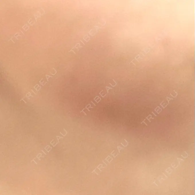 糸リフト / 脂肪吸引（顔） / ジョールファット除去 / 脂肪吸引注射（顔） ziz CLINIC DAY 11 メイン用