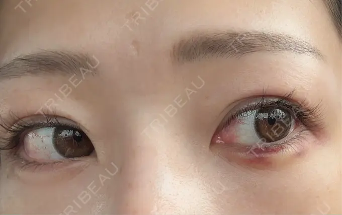 ヒアルロン酸注入（涙袋） 新宿TAクリニック DAY 2 メイン用