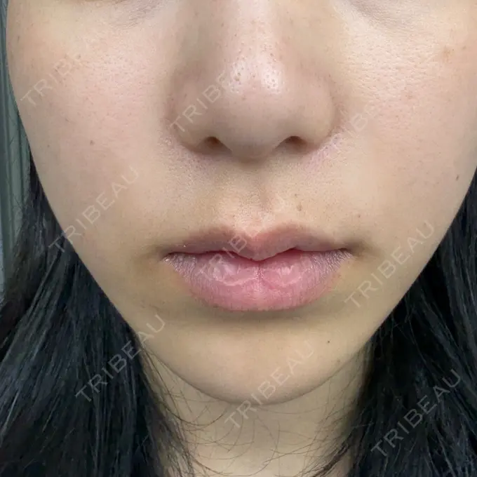 ルメッカ さっぽろ美容クリニック DAY 0 メイン用