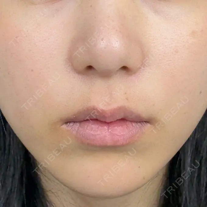 ルメッカ さっぽろ美容クリニック DAY 0 メイン用