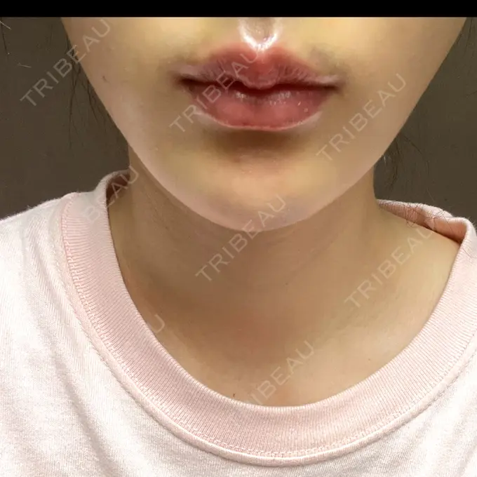 糸リフト アリエル美容クリニック 横浜院 DAY 5 メイン用