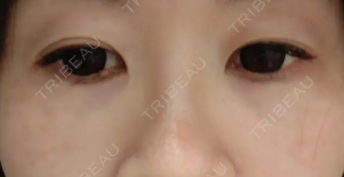 ヒアルロン酸注入（目の下） SOL CLINIC DAY 2 メイン用