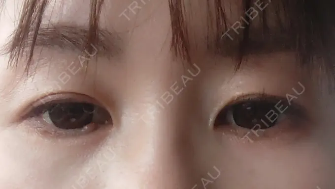 ヒアルロン酸注入（目の下） SOL CLINIC DAY 3 メイン用